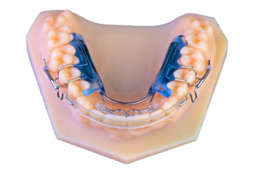 Model of teeth showing how removeable aligners fixed in the mouth